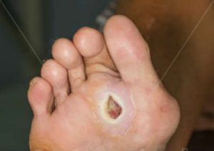 ulcera piede diabetico
